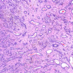 Fibromyalgie Histologie von Chronische Gelenkentzuendung