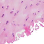 Knorpelfragment-Vorstufe Arthrose Bildung zum Osteophyten