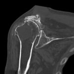 Schultergelenk fortgeschrittene Arthrose CT Rekonstruktion