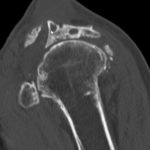 Schultergelenk fortgeschrittene Arthrose CT Rekonstruktion sagital