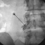 Wurzelblock-Minimalinvasive Schmerztherapie Radikulographie L4 links PRT 2
