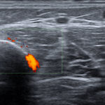 portverletzung-Muskulatur Überlastung Hypervaskularisation Sonographie