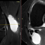Arthrose Knie MRT sagital + axial T2 Chronische Schmerzen Poplitealzyste