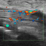 Doppler Sonographie bei Akutem Gichtanfall