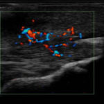 Entzündung Synovialitis-Sehen Doppler