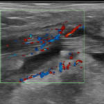 Farbdoppler bei Massiver Sehenscheidenentzündung Fuß