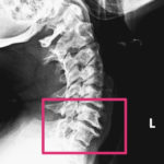 HWS Roentgen Seitlich Vakuumphaenomen Bandscheibenfach Spondylophyt