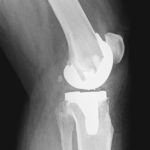 Knie-Prothese Oberflächenersatz Röntgen seitlich
