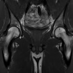 MRT Hüfte Corona T1 Ausschluss Tumor