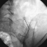 Minimalinvasive Schmerztherapie Infiltration sacroiliacal Gelenk rechts