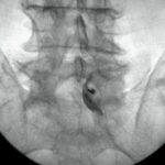 Minimalinvasive Schmerztherapie Lumbal epidurale steroid injektion LESI L5 S1 re Roentgenkontrastmittel Epidural