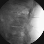 Minimalinvasive Schmerztherapie Lumbal epidurale steroid injektion LESI L2 3 seitlicher Strahlengang