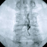 Minimalinvasive Schmerztherapie Lumbal epidurale steroid injektion LESI L4 5