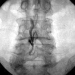 Minimalinvasive Schmerztherapie Lumbal epidurale steroid injektion LESI L4 5 Roentgenkontrastmittel Epidural