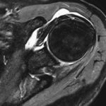 Schulter Arthritis im MRT