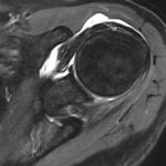 Schulter Entzuendung MRT T2