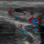 Sonographie-Powerdoppler Sehenscheidenentzündung
