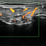 Sonographie Sehenescheidenentzündung mit Powerdoppler