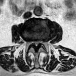 Spinalkanalstenose LWS MRT