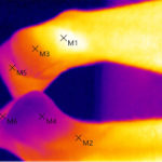 Sportmedizin Überlastung Thermographie Fersen