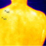 Thermographie Schultern